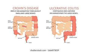 Image result for boala crohn si schizofrenie paranoida