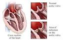 Bacterial endocarditis of the aortic valve: Healthwise Medical ...