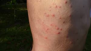 Image result for bed bug bites