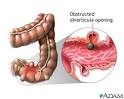 Diverticulitis Symptoms and