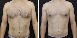 Image result for manboobs