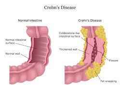 Image result for boala crohn si schizofrenie paranoida