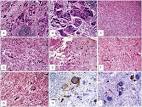 ScienceDirect.com - Human Pathology - Pleomorphic giant cell ...