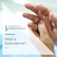 Attēlu rezultāti vaicājumam “Scleroderma”