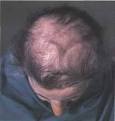 Treatment Found to Reverse Hair Loss!
