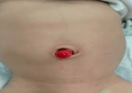 Attēlu rezultāti vaicājumam “Diderma umbilicatum young”