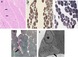 Attēlu rezultāti vaicājumam “Tetanops myopina”