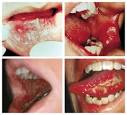 <b>Mucositis</b>