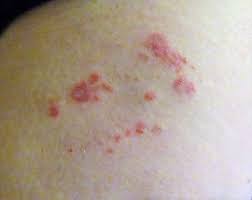 Image result for bed bug bites