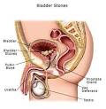 What does Bladder stones look like? Are you also searching for ...
