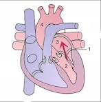 File:Mitral Regurgitation scheme1.png - Wikipedia, the free ...