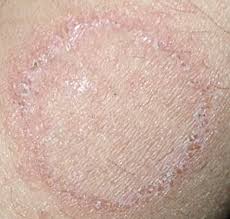Image result for tinea corporis