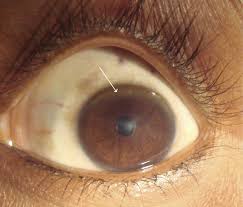 Kuvahaun tulos haulle Kayser-Fleischer