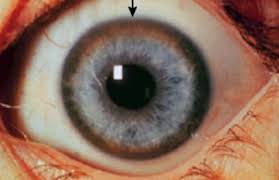 Kuvahaun tulos haulle Kayser-Fleischer