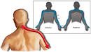 Cervical <b>Radiculopathy</b>