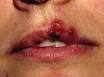 Herpes simplex (cold sores). DermNet NZ