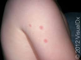 Image result for bed bug bites