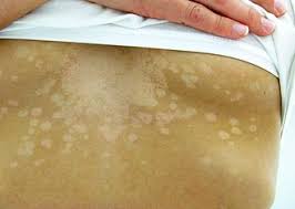 Image result for tinea corporis