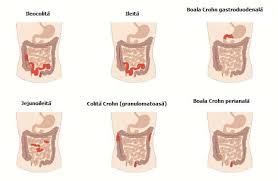 Image result for boala crohn si schizofrenie paranoida