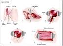 Appendectomy - procedure, recovery, blood, removal, pain ...