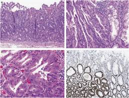 Attēlu rezultāti vaicājumam “Diderma simplex sessile”
