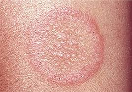 Image result for tinea corporis