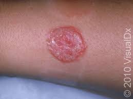 Image result for tinea corporis