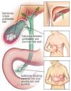 Bile Duct Diseases Guide: Causes, Symptoms and Treatment Options