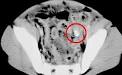 <b>Psoas abscess</b>