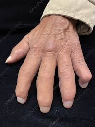 Attēlu rezultāti vaicājumam “Scleroderma”