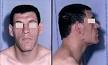 a patient with <b>acromegaly</b>.
