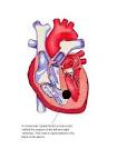 Ventricular <b>Septal Defect</b> (