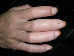 Attēlu rezultāti vaicājumam “Scleroderma”