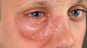 Attēlu rezultāti vaicājumam “Diderma simplex”