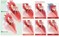 Evolving indications for transcatheter mitral edge-to-edge repair ...