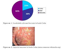 Image result for boala crohn si schizofrenie paranoida