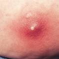 Pictures Of Skin Boils.............And Treatment Information