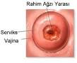 Rahim ağzında yara,rahim ağzı yarası,Erozyone Servisit Servikal ...