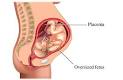 Definition of «<b>Macrosomia</b>»