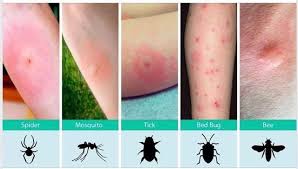 Image result for bed bug bites