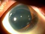 Photo of <b>aniridia</b>