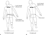 The Trendelenburg <b>gait</b> is very