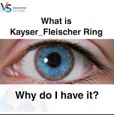 Kuvahaun tulos haulle Kayser-Fleischer