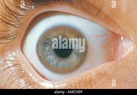 Kuvahaun tulos haulle Kayser-Fleischer