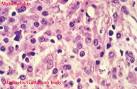 <b>Malacoplakia</b>
