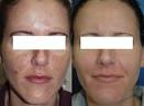 Fraxel Laser Treatment Fraxel Laser Treatment Scottsdale ... - FRpigbeforeafter3