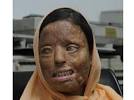 Nine years after an acid attack left Sonali Mukherjee blind in both eyes, ... - NorthIndia_1_Front_1142304g