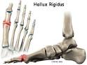<b>Hallux</b> rigidus is a