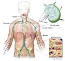 primary CNS <b>lymphoma</b> can