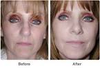 Chemical Peels &amp; Skin Treatments by Newport Beach Cosmetic Surgeon ...
